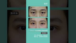 仿生理雙眼皮+隱痕祛眼袋案例 #eyebag #眼袋內開 #雙眼皮 #雙眼皮手術 #eyebagremoval