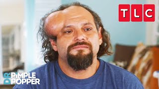 This Man Feels Like a Monster | Dr. Pimple Popper | TLC