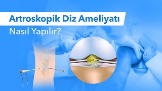 Diz Artroskopisi Nedir? Kapalı Diz Ameliyatı Nasıl Yapılır? Avantajları ve Riskleri