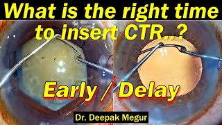 What is the right time to insert a CTR - Dr. Deepak Megur