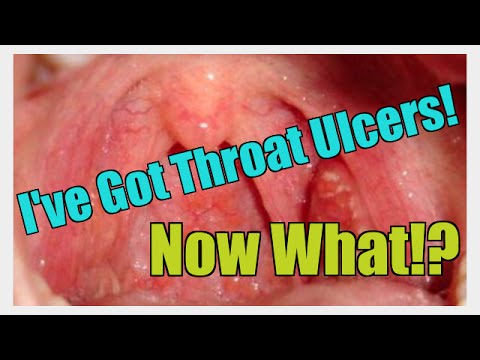 I've Been Told I Have Throat Ulcers! Now What? I've Been Told I Have Throat Ulcers! Now What?