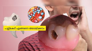 പല്ല്കേട് എങ്ങനെ അടയ്ക്കാം #toothdecay