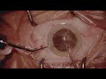 8k cataract surgery