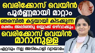 വെരികോസ് വെയ്ൻ മാറ്റാനുള്ള അടിപൊളി വ്യായാമം ഇതാണ്    | VERICOSEVEIN TREATMENT