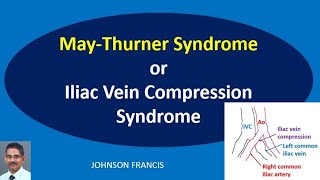 May Thurner Syndrome or Iliac Vein Compression Syndrome