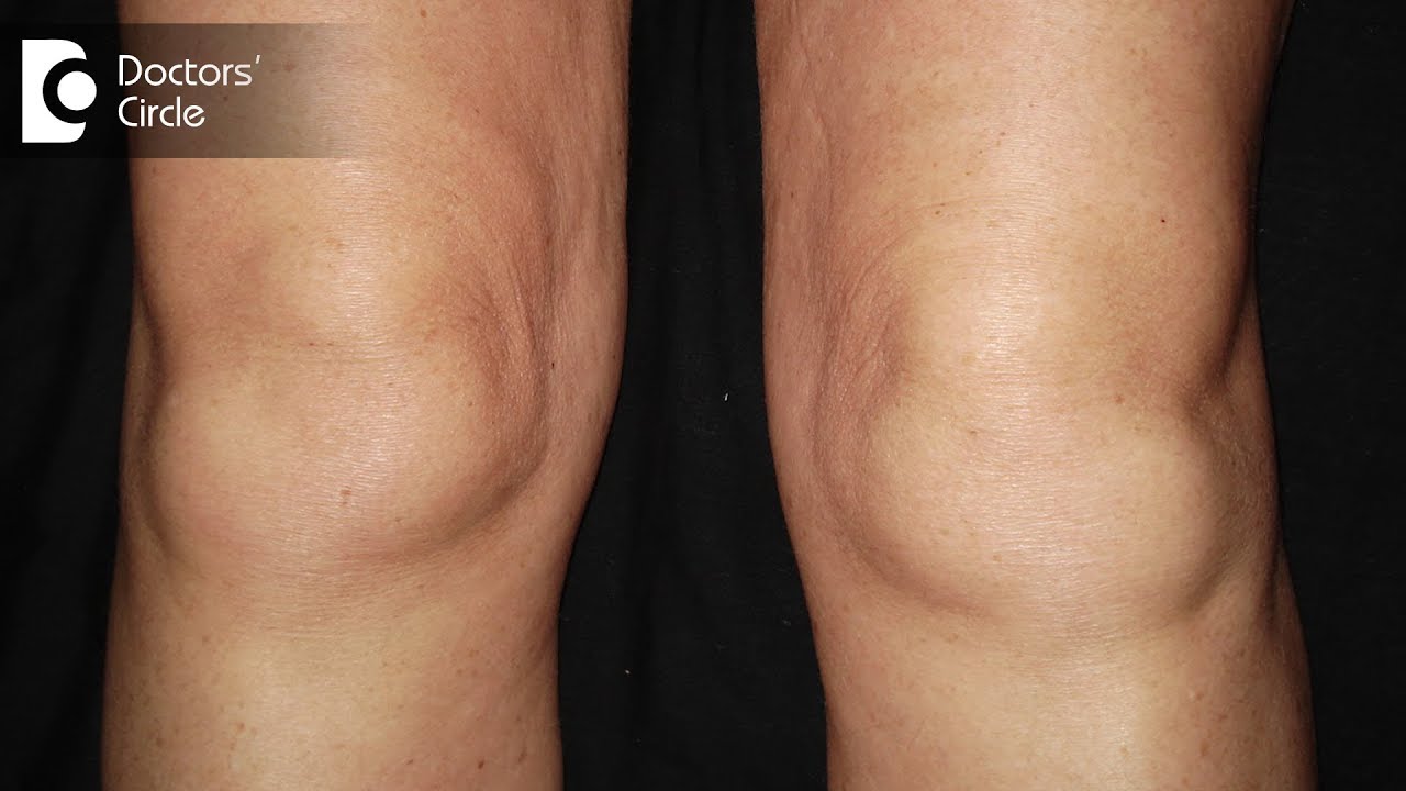 Knee Swelling Knee Swelling 3 Months After Meniscus Surgery Dr
