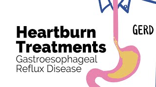 Treatments for Heartburn | Gastroesophageal Reflux Disease (GERD) | Gastrointestinal Society