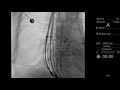 Use of multiple covered metal esophageal stents for treatment of Boerhaave syndrome in achalasia