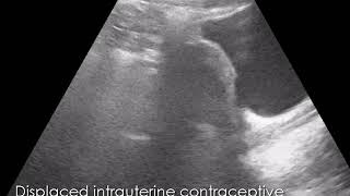 CASE 821 Displaced intrauterine contraceptive device IUCD in lower  intrauterine  segment