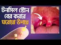 ঘরে বসে টনসিল স্টোন বের করার নিরাপদ উপায় | Tonsil Stone Treatment | Dr Muntasir Mahbub