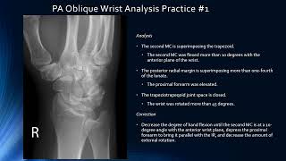 Image Analysis -Upper Extremity -Thumb, Wrist, Forearm, Elbow