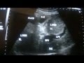 LIVER CIRRHOSIS with PORTAL HYPERTENSION-1_x264.mp4