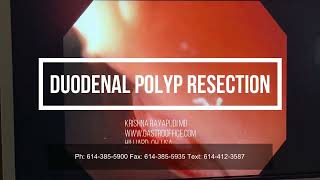 Duodenal (small bowel) Polyp Removal