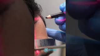 Hair Transplant Surgery in Turkey