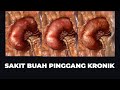 PENYAKIT BUAH PINGGANG KRONIK (PUNCA & RAWATAN)