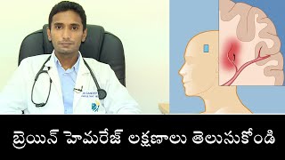 Causes of Brain Hemorrhage And Symptoms | బ్రెయిన్ హెమ‌రేజ్ ల‌క్ష‌ణాలు తెలుసుకోండి