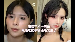 磨骨也会反弹？术后一年后情况汇报，为什么依然是大饼脸？颧骨内推，下颌骨削骨恢复情况