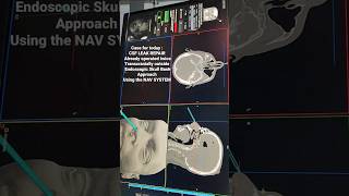 CSF LEAK REPAIR With Neuro-Navigation System 🧠 📺  Surgery link : In Description below 👇