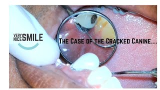 Extracting a fractured upper canine (tooth #11)