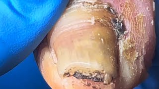 Onychomycosis Is Full Of Black Mud, And It’S Too Dirty To Remove The Nails!【Pedicure Master Lin Jun】