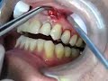 Popping a Dental Abscess