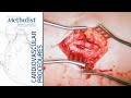 Brachial Artery Thromboembolectomy Using a Fogarty Catheter (Alan Lumsden, MD; M. Mujeeb Zubair, MD)