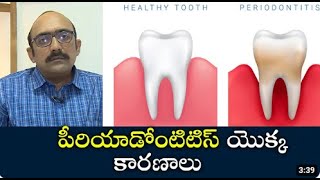 Causes of Periodontitis   పీరియాడోంటిటిస్ యొక్క కారణాలు