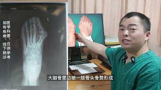 拇外翻拇囊炎及矫正，典型拇囊炎和矫正-hallux valgus