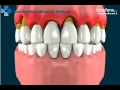 gingival changes in periodontal disease