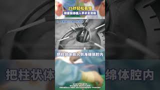 25秒轻松看懂！阴茎假体植入手术全流程 医学科普 男性健康 硬核健康科普行动