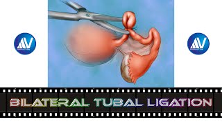 Puerperal Tubal Ligation