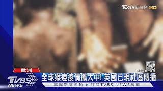 全球猴痘疫情擴大中! 英國已出現社區傳播｜TVBS新聞