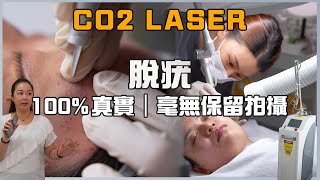 脫疣 CO2 Laser 二氧化碳激光｜疣其實是什麼？家用儀器能去除是真的嗎？｜一個正常去疣過程是怎樣？｜為什麼做完去疣療程，皮膚反而更差了？ #medskinHK