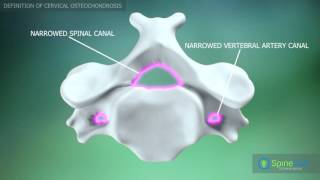 Cervical Osteochondrosis. Definition