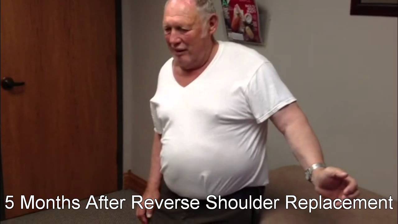 Reverse Total Shoulder Replacement Before After 55 Off