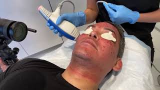 CLEAR + BRILLIANT LASER TO LOOK YOUNGER | MALE FACIAL REJUVENATION PART 4 | Dr. Jason Emer