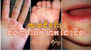 ជំងឺពងបែកនៅដៃជើងនិងមាត់ | Hand Foot and Mouth Disease | Dr Chea Kimhour