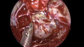 Endoscopic pituitary surgery: transsphenoidal approach