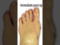 Minimally Invasive Bunion Surgery: Before and After! #shorts