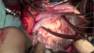 Mitral Valve Measurements - Dr. Tirone David