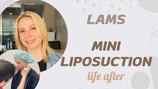 [collaboration] life after mini liposuction | lams | 365mc