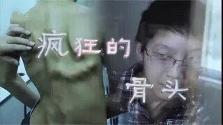 《故事大王》男孩患病十年骨頭瘋狂亂長，世所罕見無有效治療辦法#奇聞#懸疑#真相