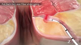 Fistula treatment Zmed Laser