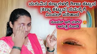 Baby eye blocked home remedy in kannada | Baby eye blocked | home remedies | Baby care tips| eyecare