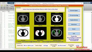 Early Stage Lung Cancer Detection Using Image Processing Matlab Source Code