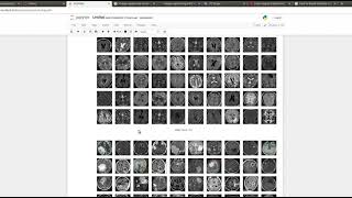 Implementation of Brain Tumor Detection & Classification using CNN TensorFlow | Python Tutorial |