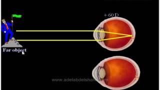 Errors of refraction for undergraduates : Introduction Errors of refraction for undergraduates : Introduction