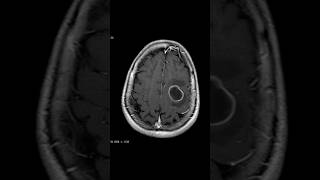 cerebral metastasis