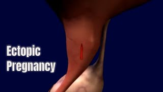 What is Ectopic pregnancy? (Medical Animation)