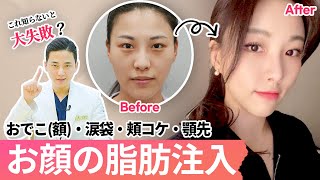 【若返り整形】顔の脂肪注入部位別の効果と定着率は？定着しやすい部位・しにくい部位を詳しく解説！【韓国JAYJUN美容外科】